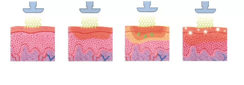 cómo funciona un dispositivo rejuvenecedor en la piel
